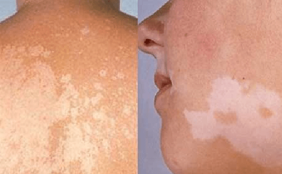 Bệnh lang ben là tình trạng da tổn thương do nấm chủ yếu là vi nấm Malassezia