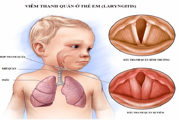 Viêm thanh quản cấp ở trẻ nhỏ ảnh hưởng đến sức khỏe của em bé vì thế các bậc phụ huynh cần lưu ý